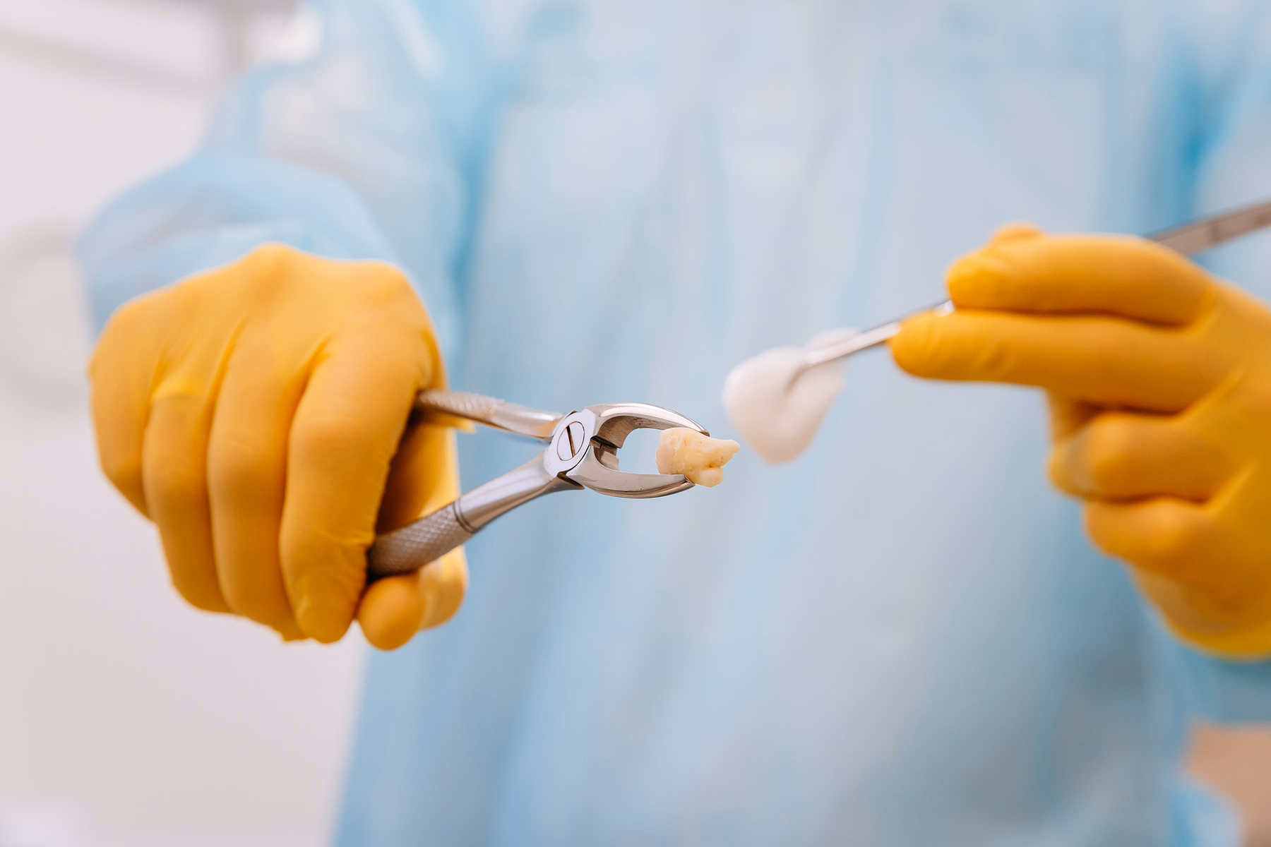 Manos enguantadas sosteniendo fórceps dentales con un diente extraído y un instrumento dental con algodón.