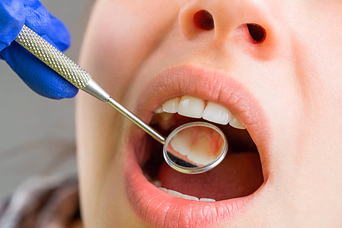 Close-up of a dental examination with a dental mirror inside a patient's open mouth.