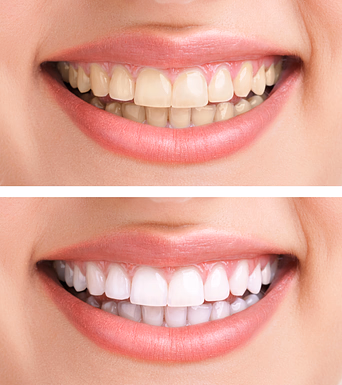 Comparison of a smile before and after teeth whitening, showing yellowed teeth in the top image and bright white teeth in the bottom image.
