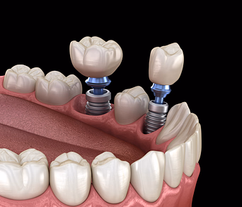 Ilustración 3D de implantes dentales con coronas protésicas colocadas en la mandíbula inferior entre dientes naturales.