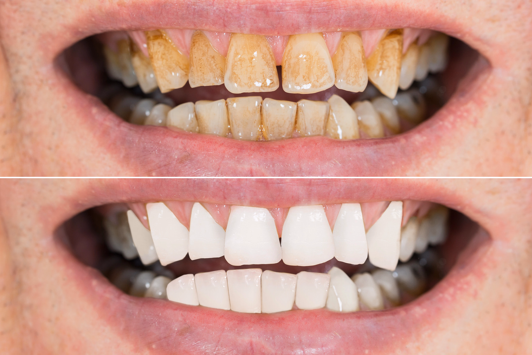 Close-up comparison of teeth before and after whitening treatment; top shows heavily stained teeth, bottom shows bright white clean teeth.