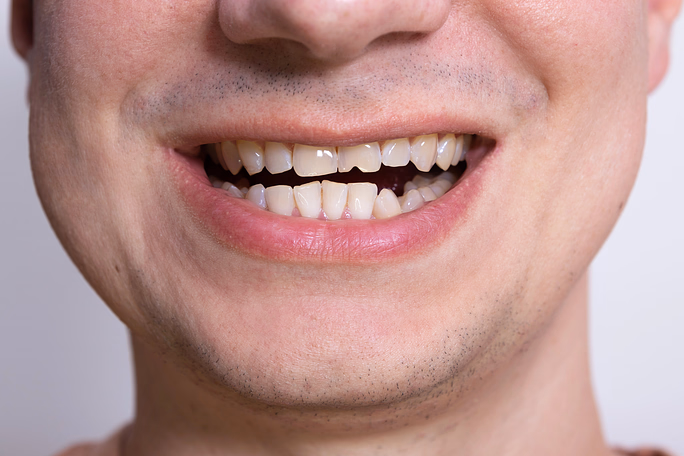 Primer plano de la boca de un hombre que muestra dientes amarillentos y desiguales y una ligera sonrisa.