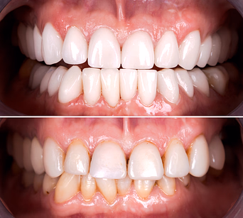 Comparison of teeth before and after whitening treatment showing significantly whiter and more even teeth in the after image.