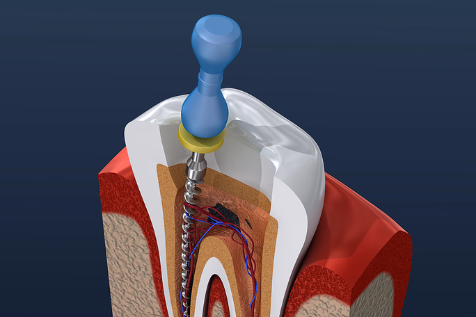Root Canals