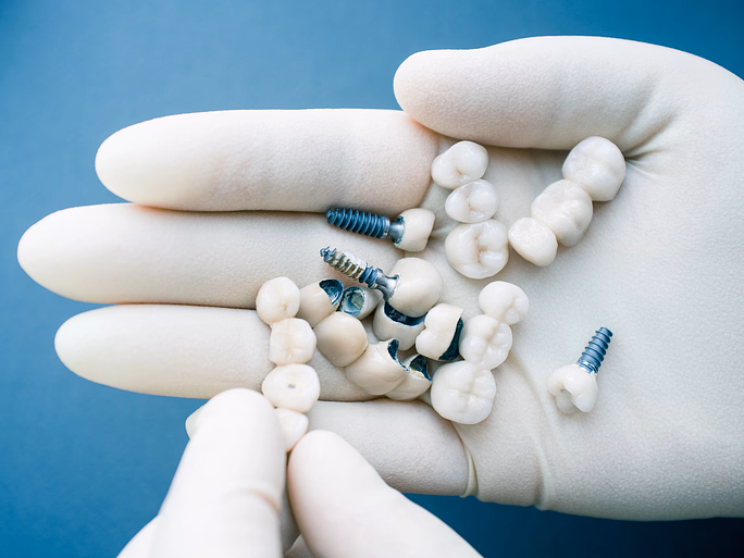 Manos enguantadas sosteniendo implantes dentales y dientes artificiales sobre un fondo azul.