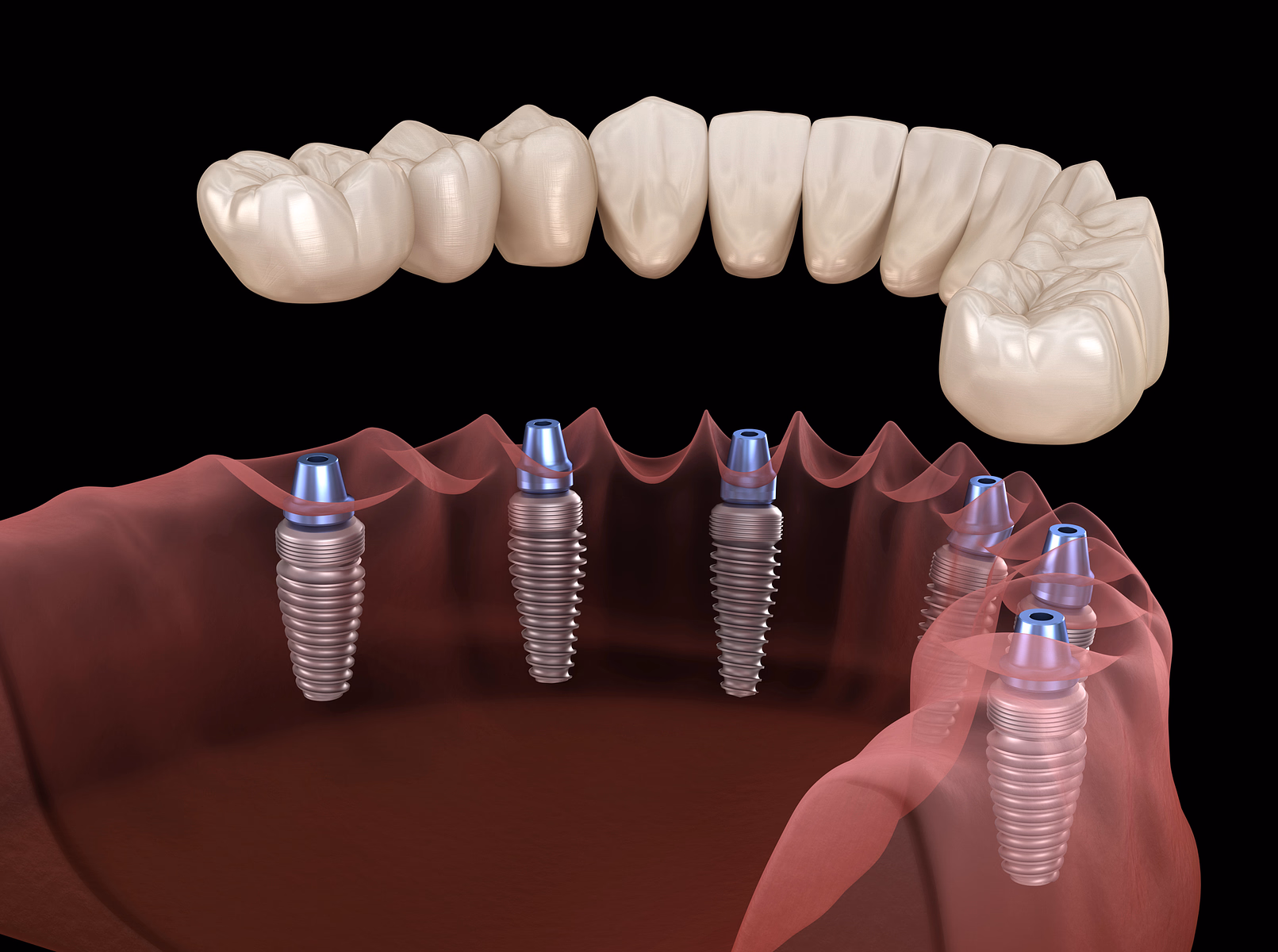 Ilustración 3D de implantes dentales insertados en el hueso de la mandíbula inferior que soportan un arco completo de dientes superiores.