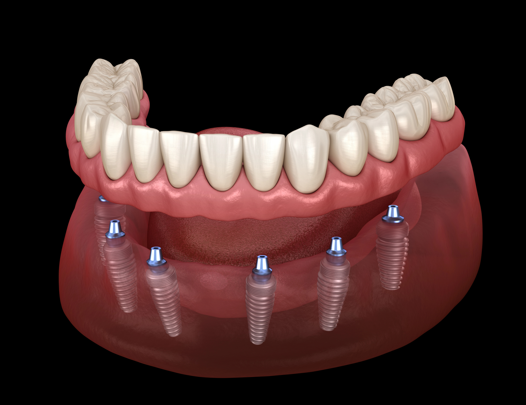 Ilustración 3D de una mandíbula inferior con implantes dentales que soportan un arco completo de dientes artificiales.