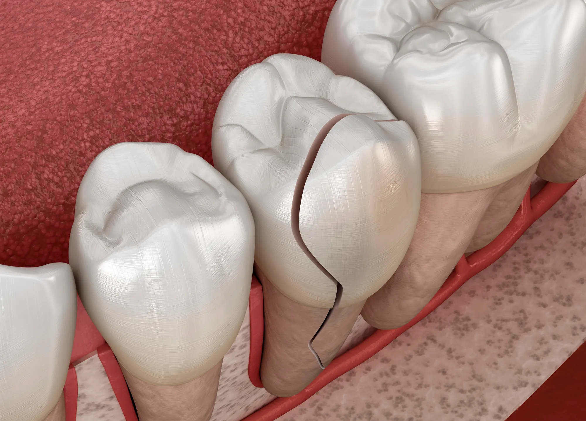 3D illustration of cracked molar tooth showing the fracture extending from the crown down to the root.