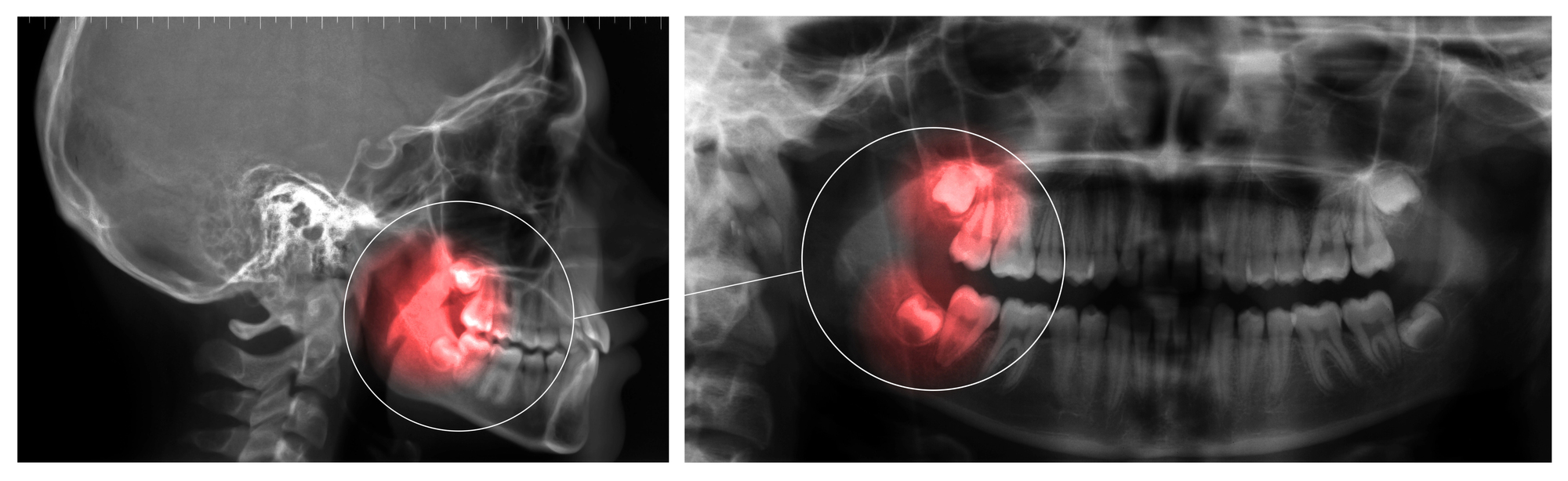 Dos imágenes de radiografías dentales que muestran muelas del juicio impactadas resaltadas en rojo dentro de un área marcada con un círculo.