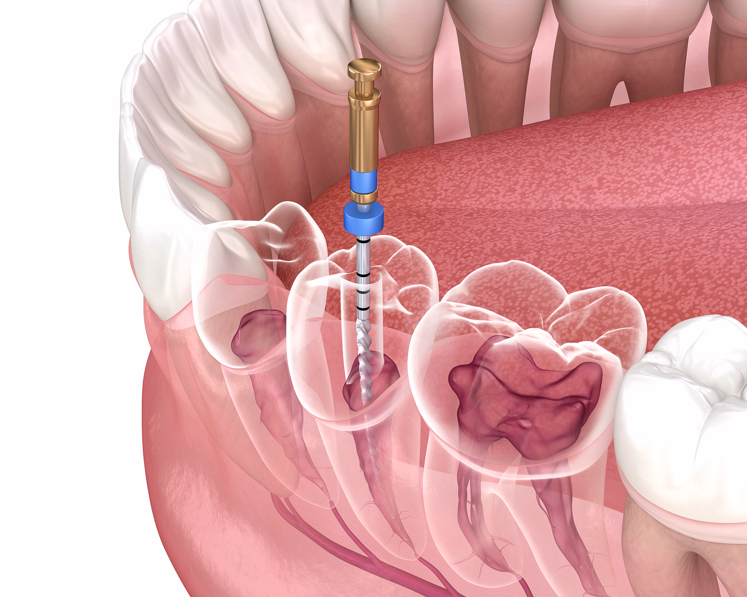Illustration of a dental root canal procedure on a molar, showing a dental file cleaning the infected root canal inside the tooth.