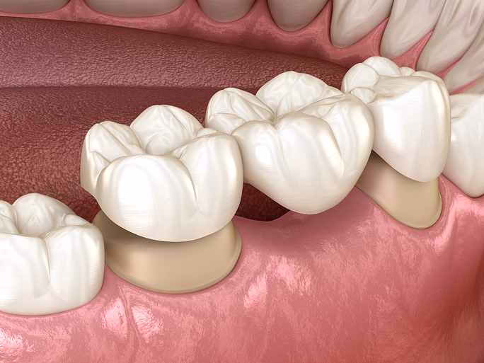 Ilustración 3D de puentes dentales que reemplazan dientes faltantes en la mandíbula inferior.