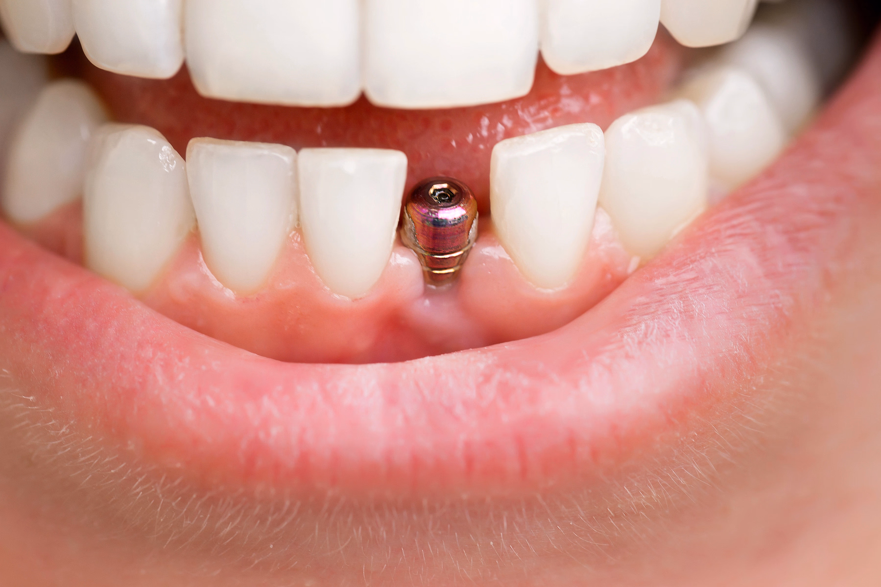 Close-up of a lower front jaw showing a dental implant in place of a missing tooth surrounded by natural teeth and pink gums.