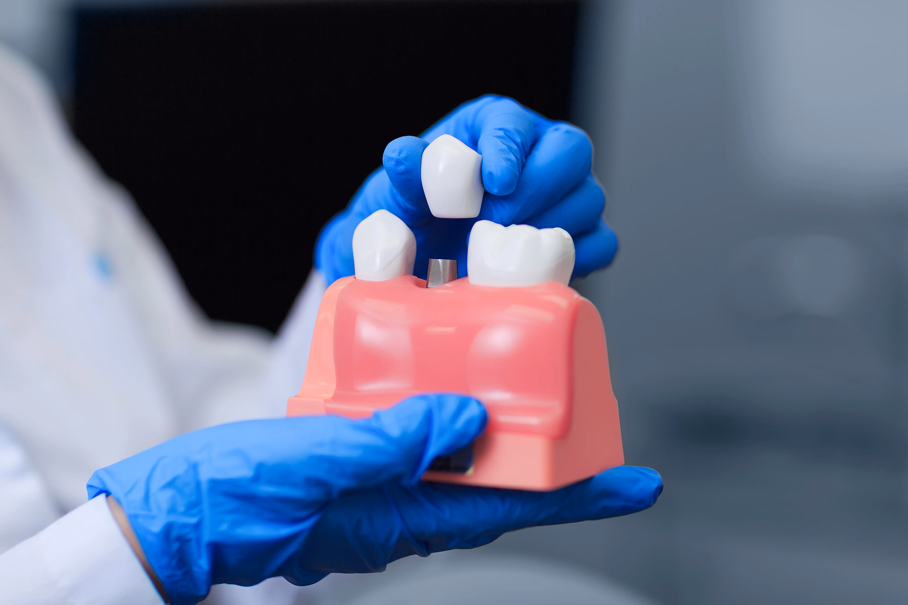 Person wearing blue gloves holding a dental model with a tooth crown being placed on an implant.