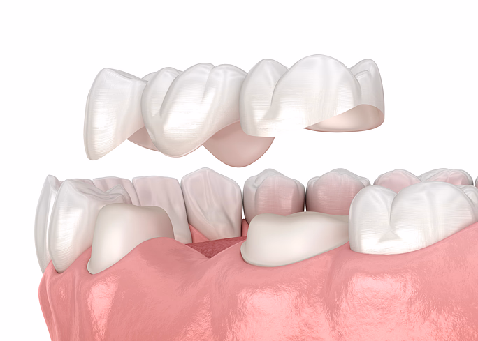 Ilustración 3D de un puente dental colocándose sobre dientes preparados en la mandíbula inferior.