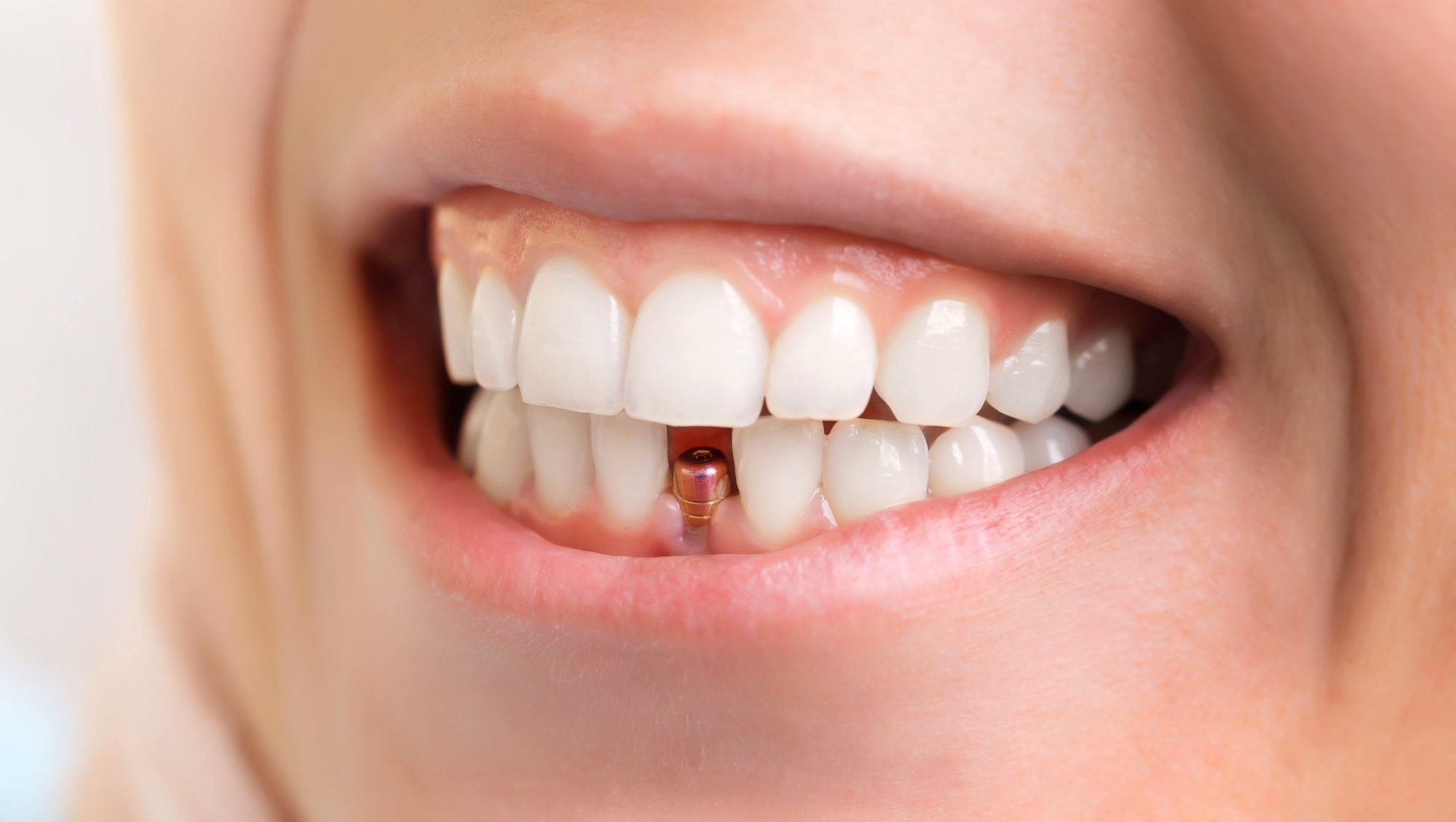 Close-up of a smile with a dental implant visible in the lower front teeth gap.