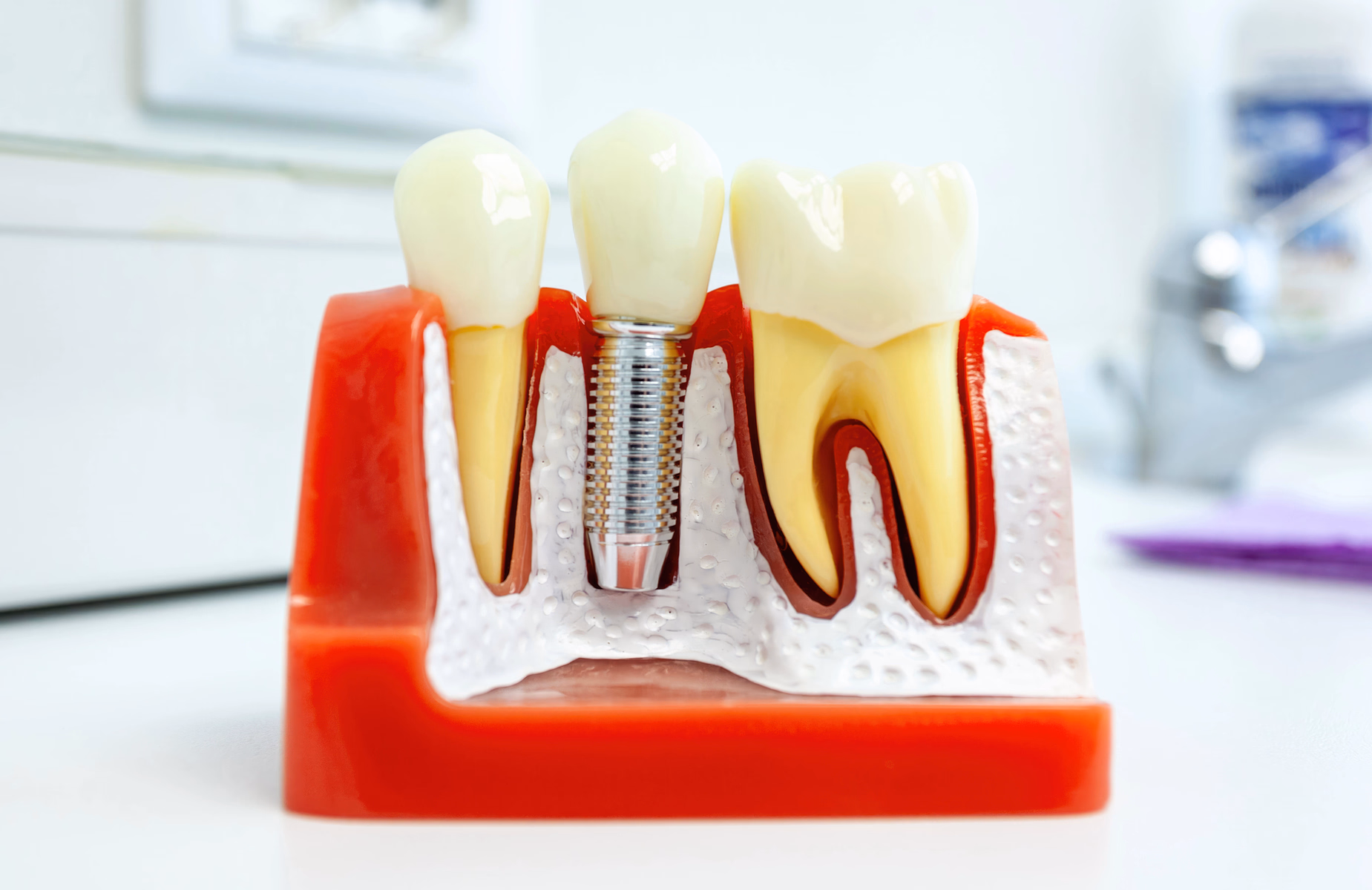 Modelo dental que muestra dientes naturales y un implante dental de metal incrustado en la encía y el hueso de la mandíbula.