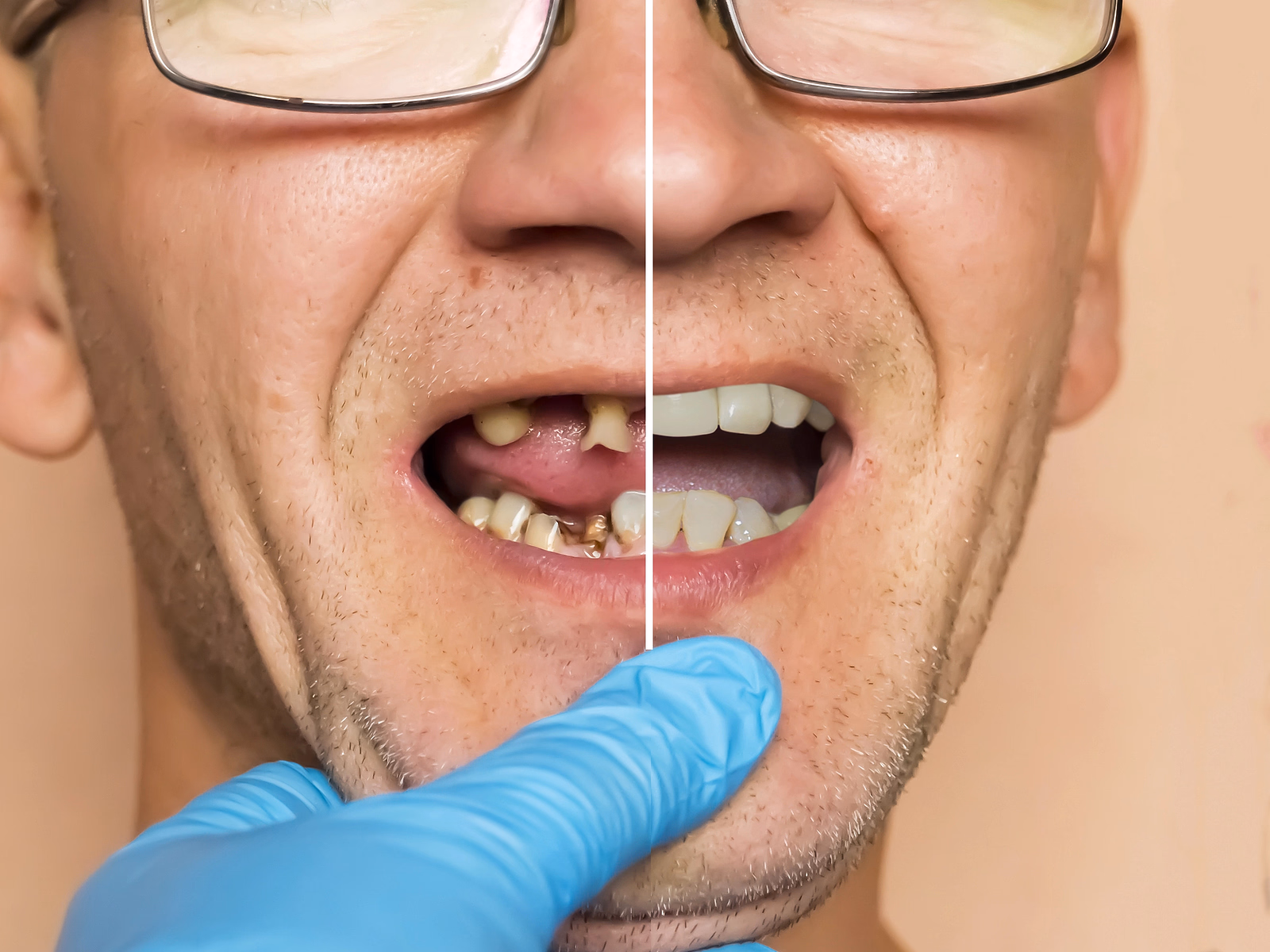 Primer plano de la boca de un hombre que muestra una vista dividida de dientes gravemente cariados a la izquierda y dientes blancos y sanos a la derecha, mantenida abierta por una mano enguantada.