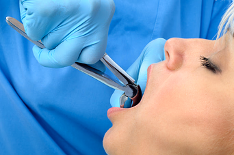 Dentista con guantes azules usando un espejo y una sonda dental para examinar la boca abierta de un paciente.